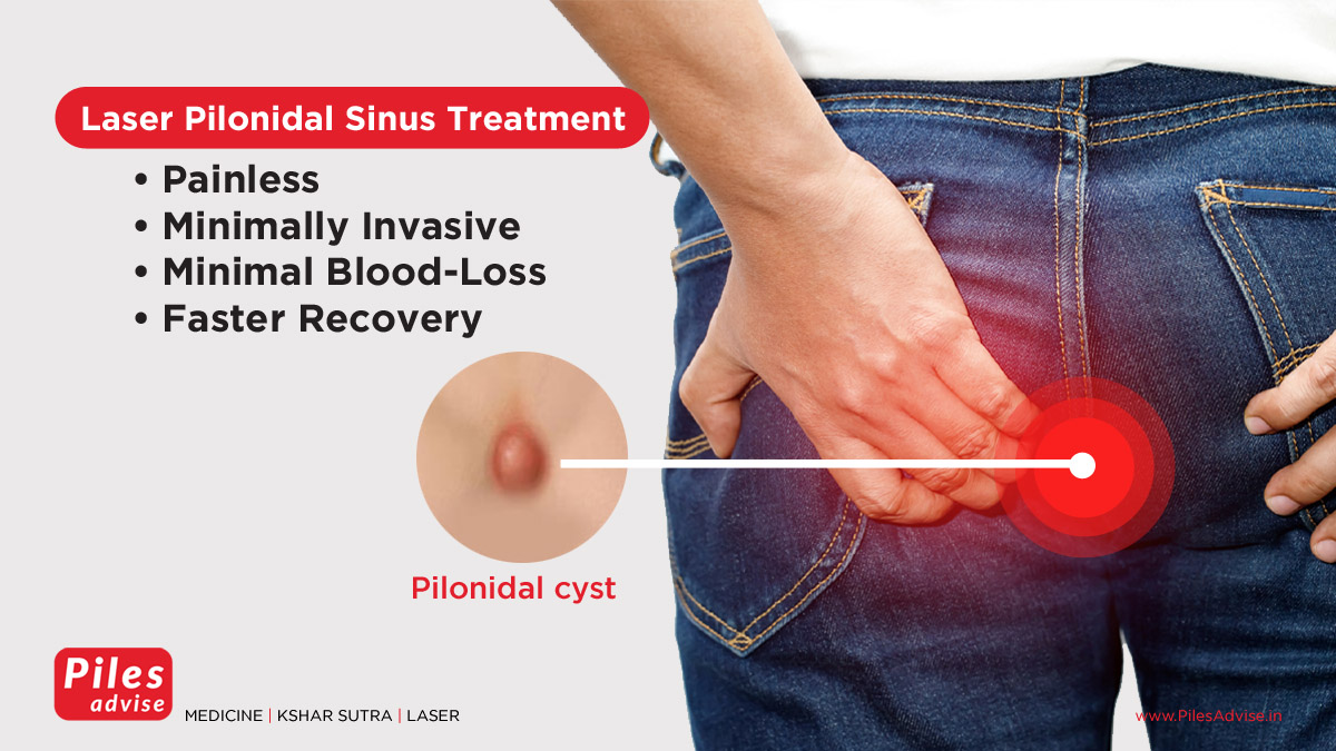 Laser Pilonidal Sinus Treatment at Piles Advise Dehradun