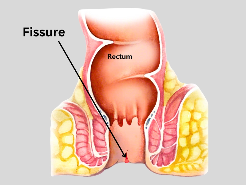 Fissure Treatment in Dehradun, Piles Advise, Piles Treatment in Dehradun