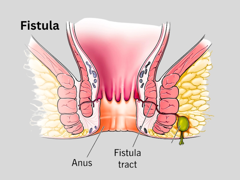 Fistula Treatment in Dehradun, Piles Advise, Piles Treatment in Dehradun