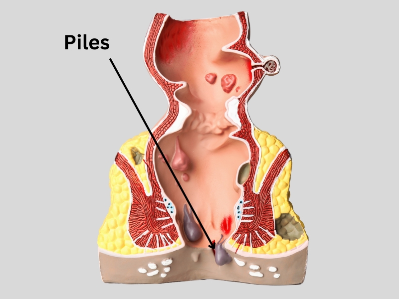 Piles Treatment in Dehradun, Piles Advise Dehradun