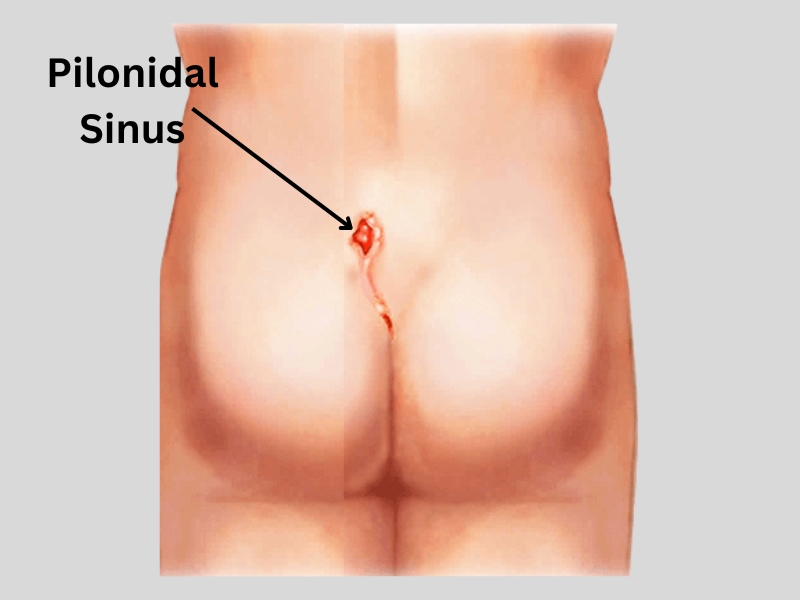 Pilonidal sinus Treatment in Dehradun, Piles Advise, Piles Treatment in Dehradun